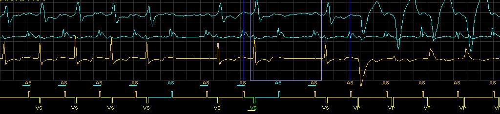 AAI(R): - MVP : AV conduction during conduction re-check AAI(R) pacing with