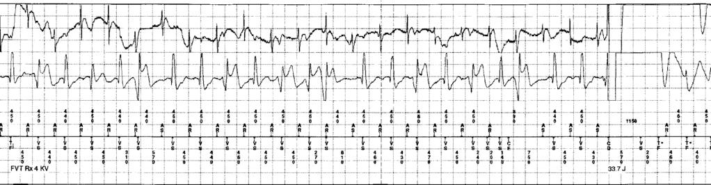 T Wave Oversensing shock therapy for