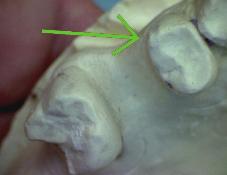 is used to view the anterior aspect in figures 4 and 5. A red arrow indicates a line angle on the premolar that is undercut relative to the candidate RPD POP. Fig. 8.