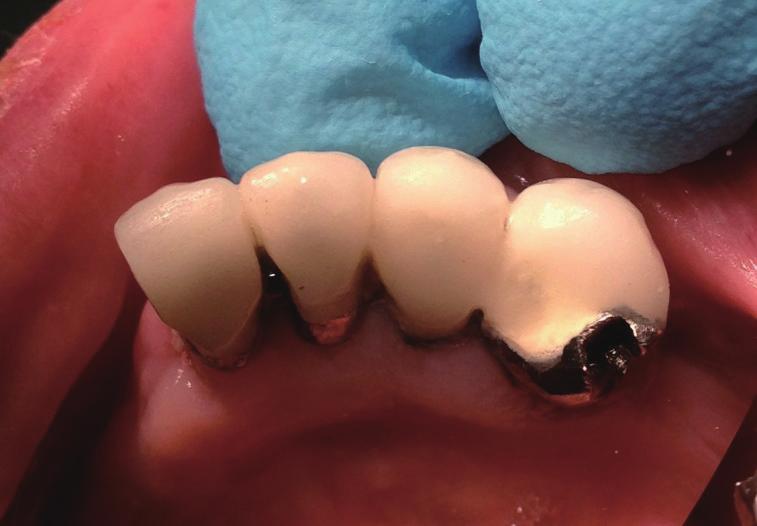 The lower right premolars were structurally weak due to large restorations.