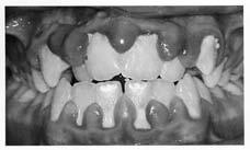 Gingival Diseases-Dental Plaque