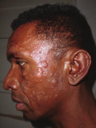 2 Case Reports in Dermatological Medicine (a) (b) (c) Figure 1: (a, b) Nodular lesions over face and trunk. (c) Nodular lesions over forearm.