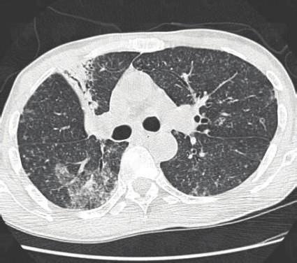 reported development of pulmonary tuberculosis after corticosteroid intake in two cases of leprosy [1]. Prasad et al.