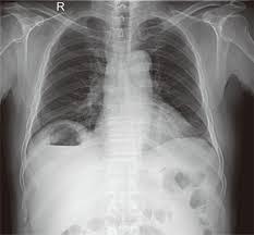 Free gas under the right diaphragm Perforation of an intraabdominal viscus is a surgical emergency and requires