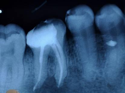 A provisional diagnosis of total pulp necrosis with chronic alveolar abcess was made and hence it was decided to carry out multi visit endodontic treatment in both the incisors.