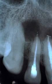 3. DISCUSSION The precise pathologic mechanism involved in the formation of periapical lesions is still unclear.