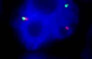 Burkitt Lymphoma Burkitt Lymphoma Starry sky pattern Diffuse proliferation of small to medium sized monomorphous cells.