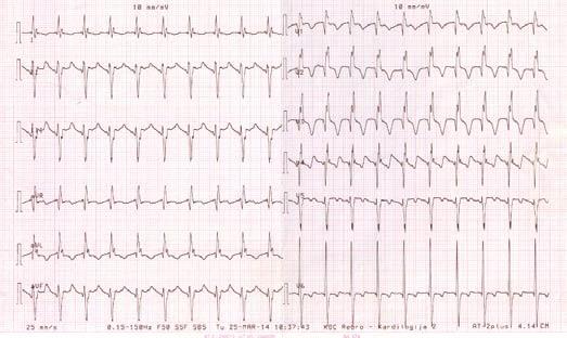 Adult Congenital Heart Disease Treatment Problems in Croatia: Organization in a Tertiary Center and Report of Three Cases Figure 1. 12-lead ECG before and after conversion.