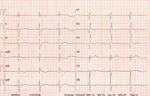 Kod dolaska u PSGO centar u EKG-u jasna undulacija atrija frekvencije 130/min, trajno prisutna i u holteru EKG-a.