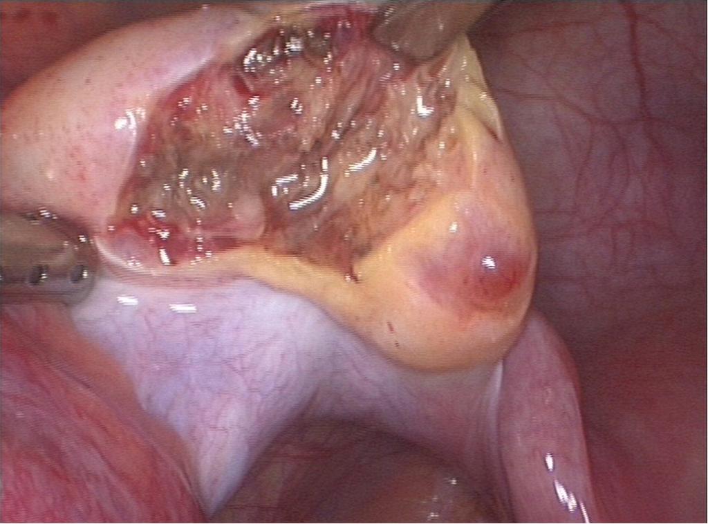 Cortical ovarian biopsy from a 12-year-old girl.