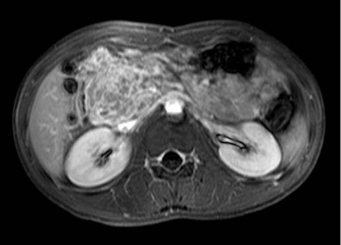 (a) Ccontrast-enhanced CT of the abdomen showed a multilobulated contoured solid mass with inhomogeneous enhancement in