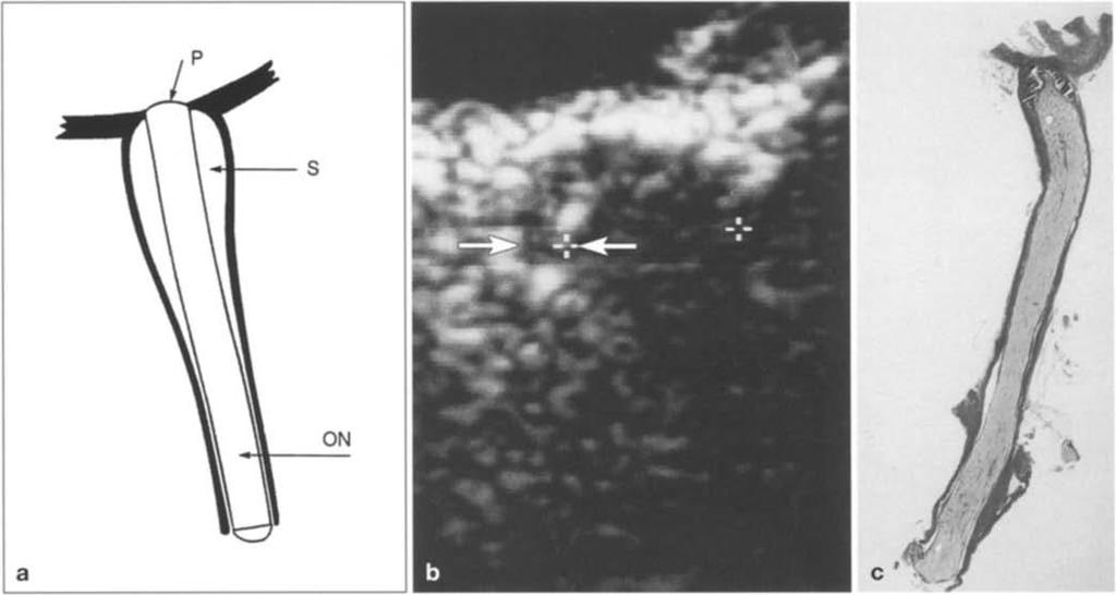 And then, there s ultrasound Fundamentals of transorbital sonographic evaluation of optic nerve sheath