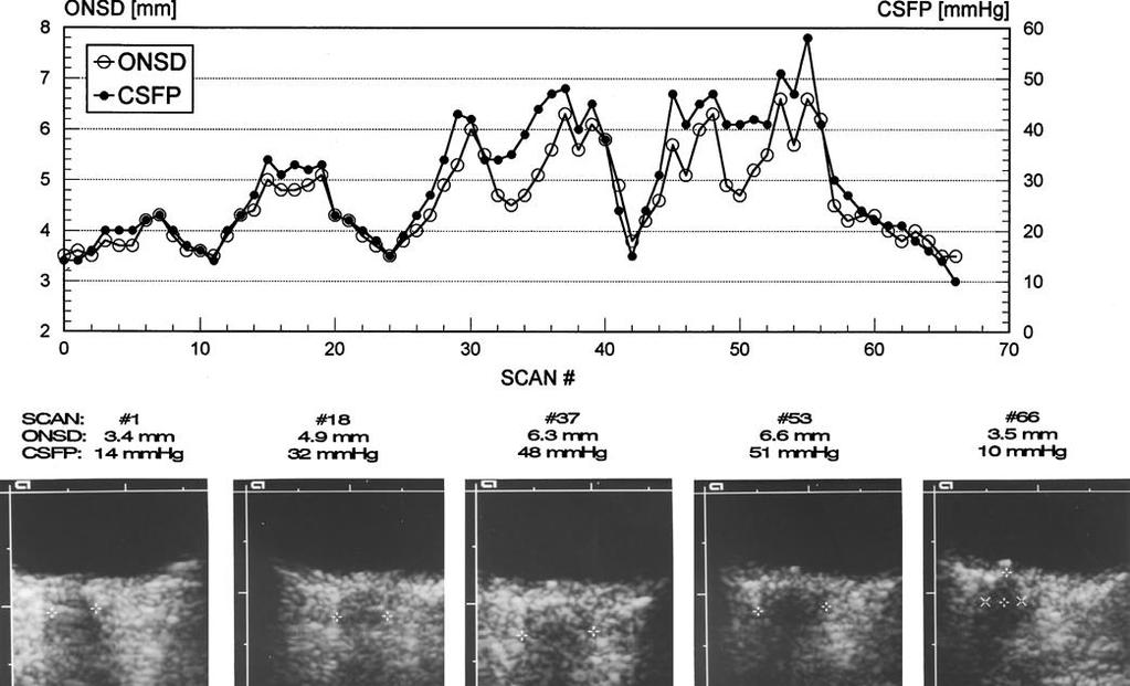 Validation of the optic nerve sheath response to changing cerebrospinal fluid pressure: ultrasound