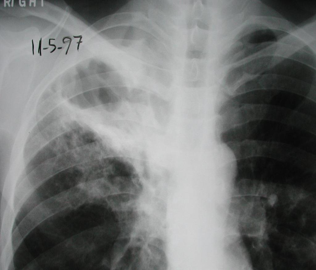 47-Year-old Ukranian Immigrant Brought to TB Clinic by Family Wt.