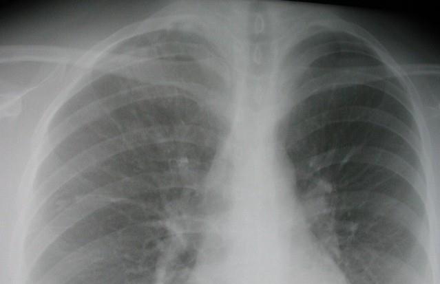 25 yr old woman, 8 mm TST, not ill Radiology reading: Fibrotic opacity in the