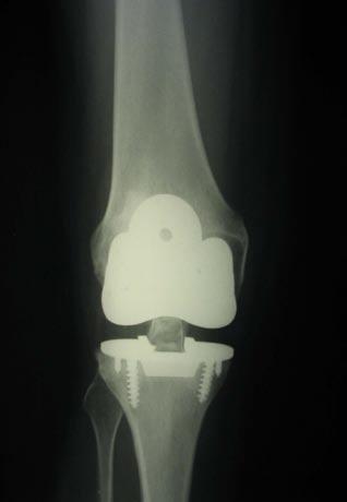 Surgical Procedure Total Knee Original System Primary Surgical Technique Where as a total hip replacement is primarily a bony operation, a total knee replacement is primarily a soft tissue operation.