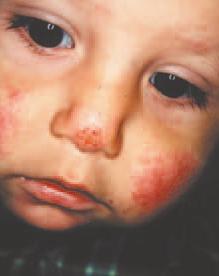 Atopic dermatitis is an acute or subacute, but usually chronic, pruritic inflammation of the epidermis and dermis.