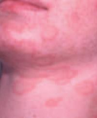 Case 4 This 25-year-old woman developed a rash five days after having an outbreak of a cold sore on her lips. She had a similar reaction one year ago. 2. What is the cause? 1.