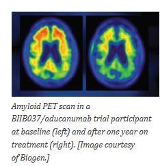Aducanumab (BII037) treatment of AD reduced brain beta-amyloid levels (phase-1-study) BIIB037 is a high affinity fully human monoclonal antibody directed towards Aβfibrils and plaques.