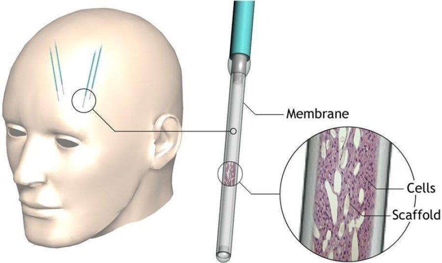 Encapsulated Cell (EC) biodelivery The tip of the EC biodelivery system is implanted in the brain of patients. It contains living cells which are genetically modified to produce a therapeutic factor.
