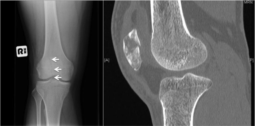 Fig. 10: Perceptual error where a fracture of the patella (arrows) was not identified on initial knee radiographs.