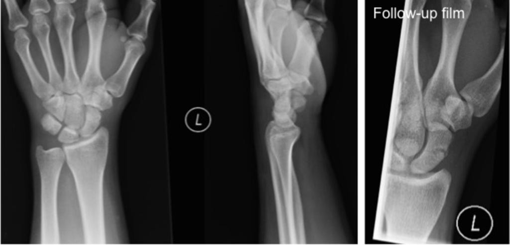 11: Perceptual error showing a fracture through the waist of the scaphoid that was not recognised on initial plain films.