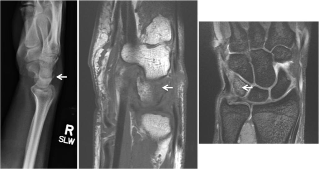 Fig. 12: Perceptual error demonstrating a triquetral fracture (arrows) that was not identified on the wrist