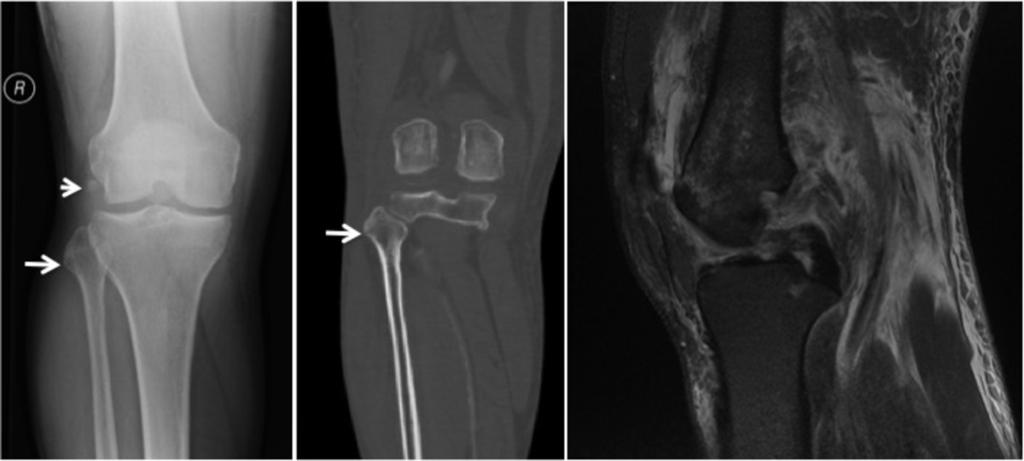 but not the medial malleolar fracture (arrow).
