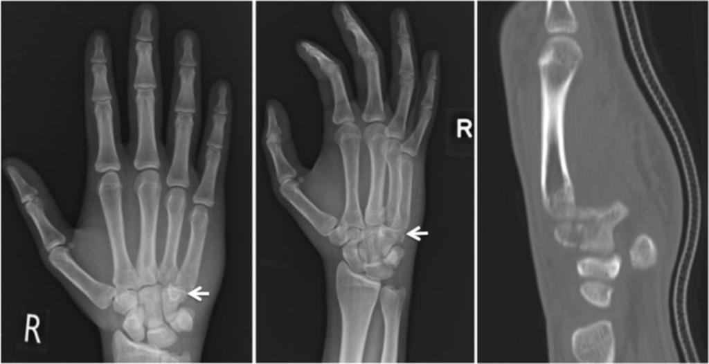 Fig. 17: Perceptual error (satisfaction of search) where the 4th metacarpal fracture was reported but not the 4th and 5th CMC joint