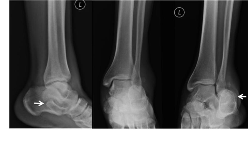 Fig. 18: Perceptual error (satisfaction of search) where the the right distal radial fracture was reported but the undisplaced distal ulna (arrow) fracture was not.
