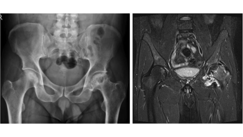 Fig. 20: Cognitive error due to faulty reasoning where this pelvis radiograph was reported as left hip degenerative change but is in fact bilateral AVN,