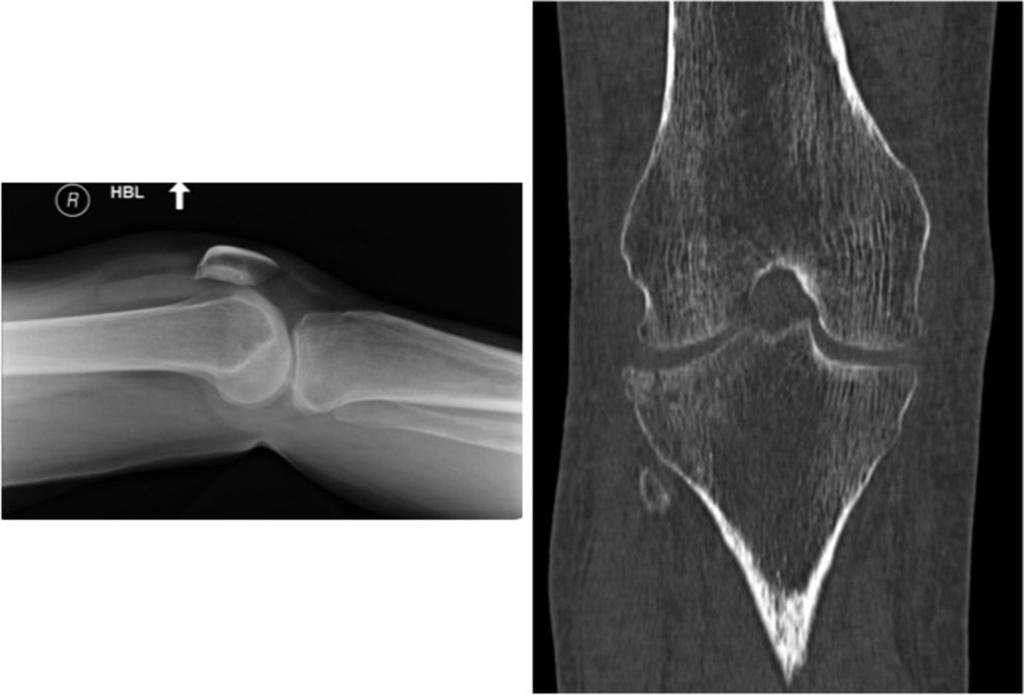 Fig. 21: Cognitive error due to faulty reasoning on a knee radiograph where a lipohaemarthrosis was interpreted as an effusion.