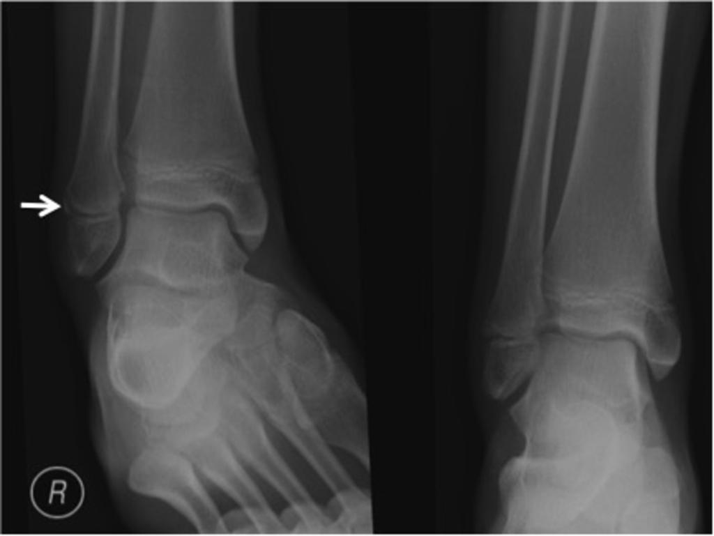 Fig. 22: Perceptual error in a child with an ankle injury.