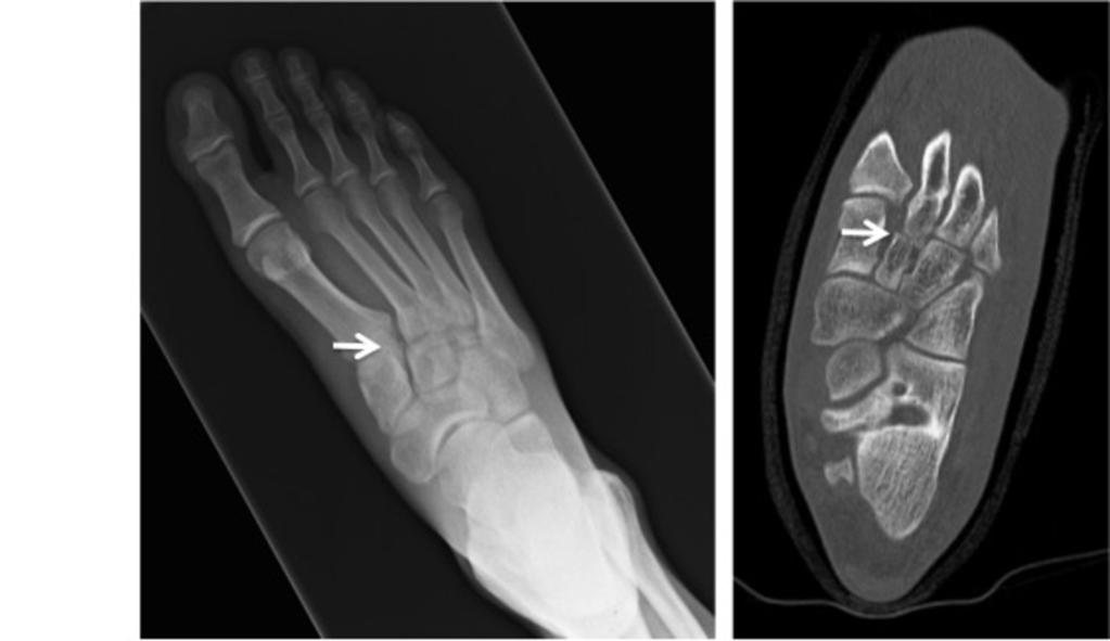 Fig. 23: Perceptual error on a foot radiograph where a Lis Franc injury (arrows) not picked up on plain film but identified