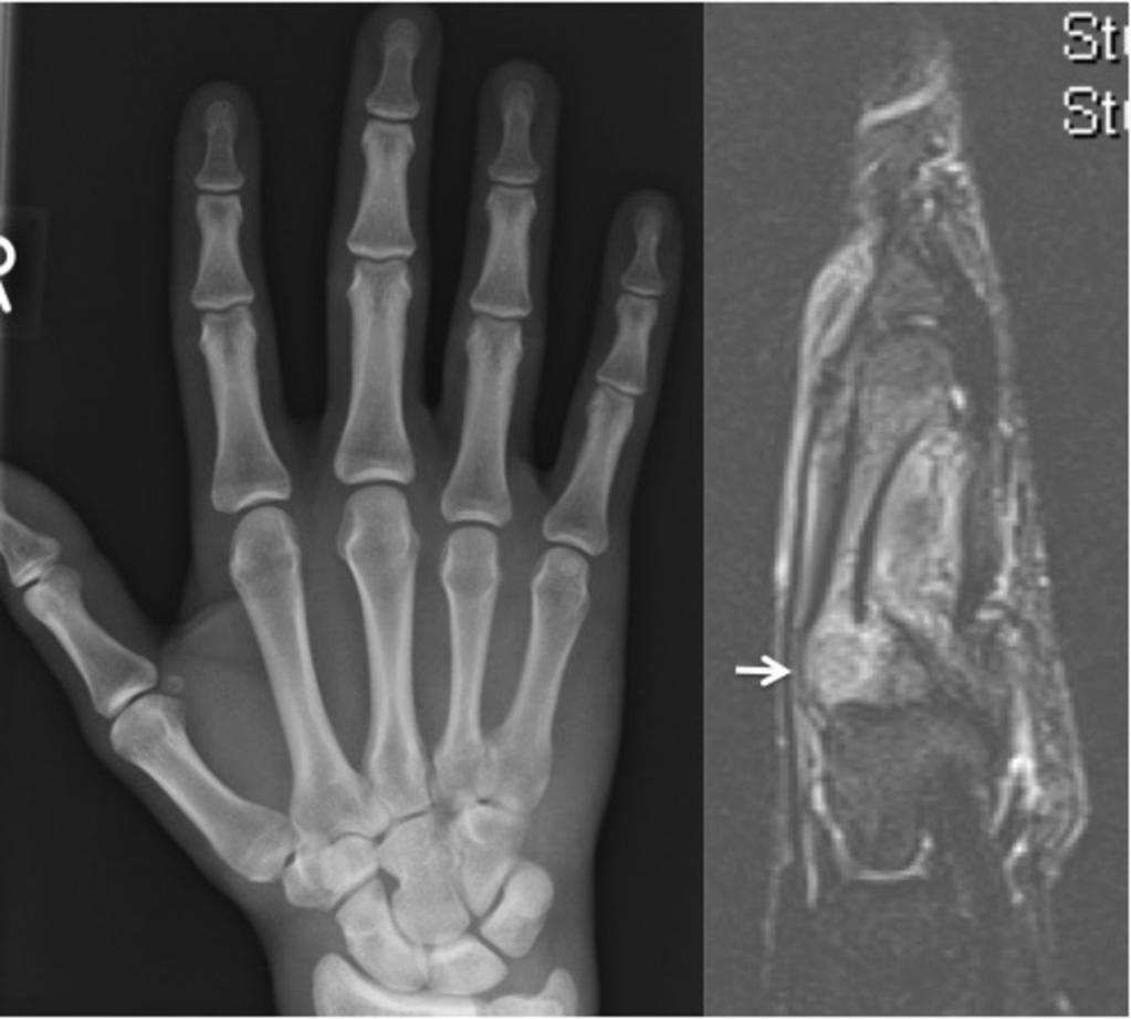 Fig. 9: Perceptual error were the 4th metacarpal fracture was not recognised.