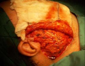 The parotid is carefully dissected from its bed and may be either wholly or partially removed as in a superficial parotidectomy that reaches down to the facial nerve and