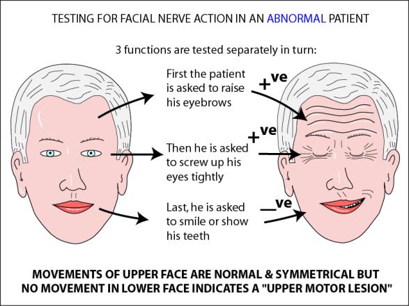 Why is the Lower Face only affected in a Stroke?