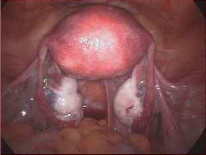 Uterus Fundus Bulging upper part of the