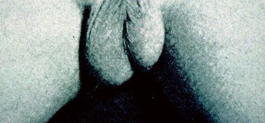 descended testes, but no penile shaft urethral opening most often on the anal verge adjacent to a small skin