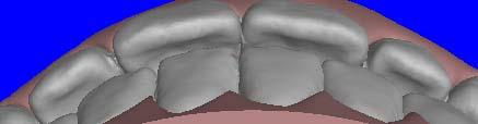 Evaluating ClinCheck Upper Occlusal with Lower Is the