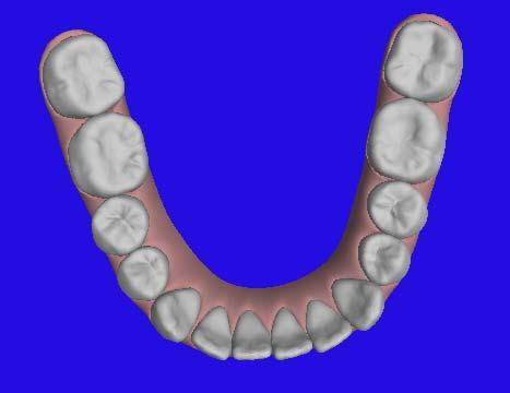 Evaluating ClinCheck Occlusal Is correction of crowding satisfactory? Is amount of proclination compatible with periodontium?