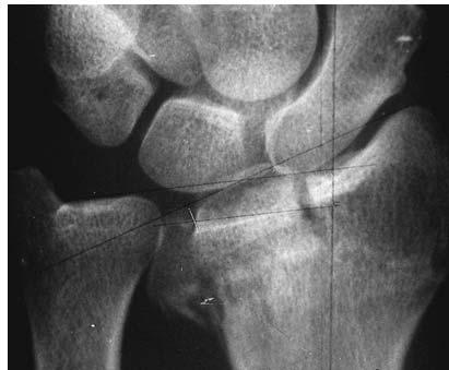 84 J. A. MEHTA, G. I. BAIN, R. J. HEPTINSTALL Fig. 5a Fig. 5a Radiographs showing a) the intra-articular fracture of the distal radius and b) postoperative anatomical reduction.