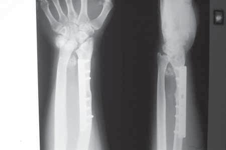 903 Fig. 3. Wrist arthrodesis in case 3 with graft resorption. Fig. 4a. Fig. 4b. Fig. 4. (a) Follow-up X-ray after 3 years showing localised soft tissue recurrence with peripheral calcification.