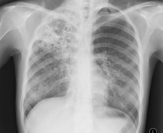 Patient Background Role of Surgery in the Management of TB Patient is a 19 year old Bolivian female who immigrated to the US in February 2002 On 3/20/02, she presenting to a hospital with complaints