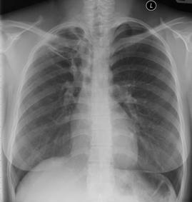 CXR 6-10-03 On June 25, 2003 patient wants to keep pregnancy; all medications were stopped On July 15, 2003,