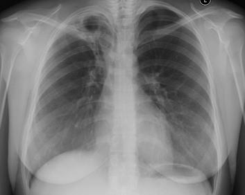 CXR 8-3-04 On 10-29-04 patient reported an episode of hemoptysis (1/2 cup) CXR done at that time was unchanged but concern is raised regarding possible relapse AFB smear x3 was negative Thoracic