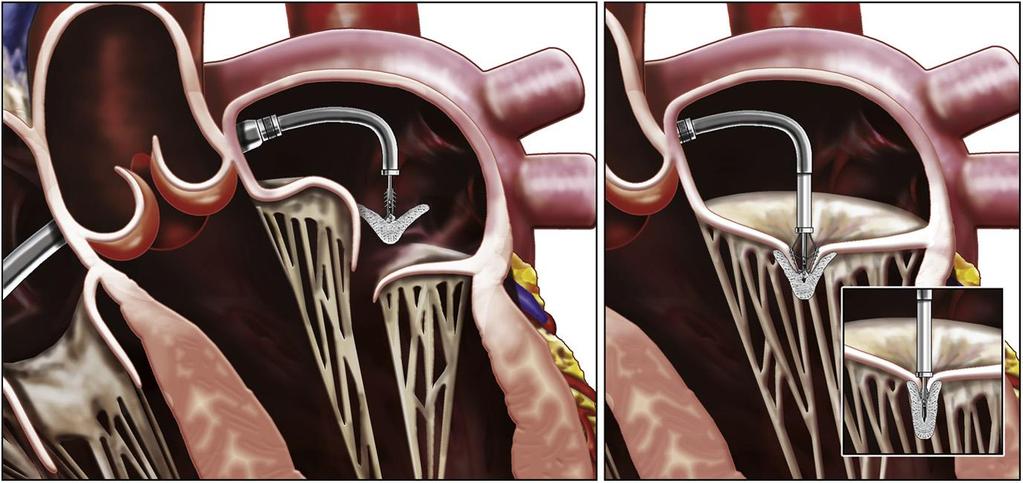 Percutaneous Strategies: MitraClip Prolapse Restricted Motion EVEREST I and II Surgical