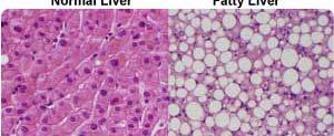 Fatty Liver/Hepatic Steatosis