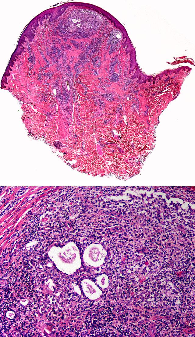 Folliculitis decalvans 5 (a) (a) (b) (b) Figure 3 Histopathological images of folliculitis decalvans, early lesion. (a) A papular lesion with a perifollicular infiltrate and early scar.