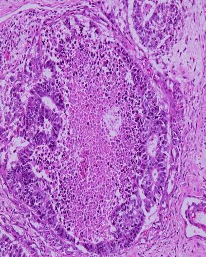Embryonal Carcinoma Sheets and Glands Interspersed loose to embryonic stroma Limited inflammatory infiltrate